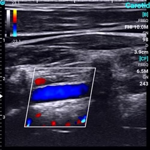 Supper Small Chison SonoEye P1 Linear Array for android Color Doppler Vascular DIAGNOSTIC ULTRASOUND MACHINES FOR SALE