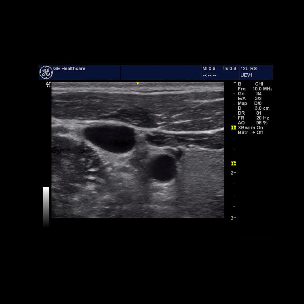 GE LOGIQ E Portable Ultrasound System Machine with 12L-RS Linear Probe DIAGNOSTIC ULTRASOUND MACHINES FOR SALE
