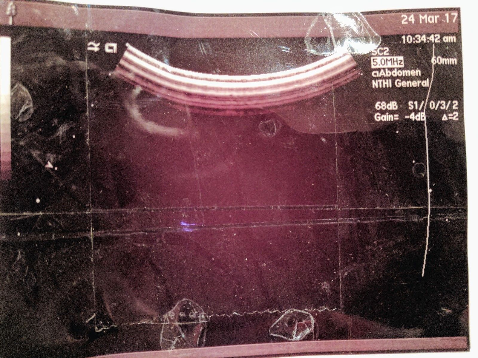 SIEMENS ACUSON 5C2 Ultrasound Transducer Probe with New Hard Carrying Case! DIAGNOSTIC ULTRASOUND MACHINES FOR SALE