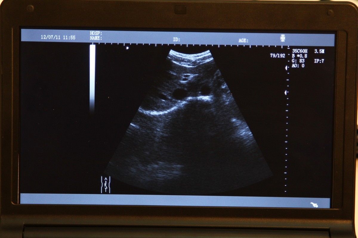 10.1'' Digital Laptop Ultrasound Scanner System W 5.0MHz Micro-convex Probe +bag DIAGNOSTIC ULTRASOUND MACHINES FOR SALE