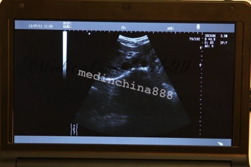Newest Laptop Ultrasound Scanner +Convex+Linear+Transvaginal 3 Probes +Free Box DIAGNOSTIC ULTRASOUND MACHINES FOR SALE